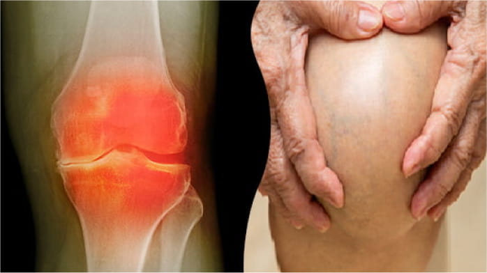Pain in the knee